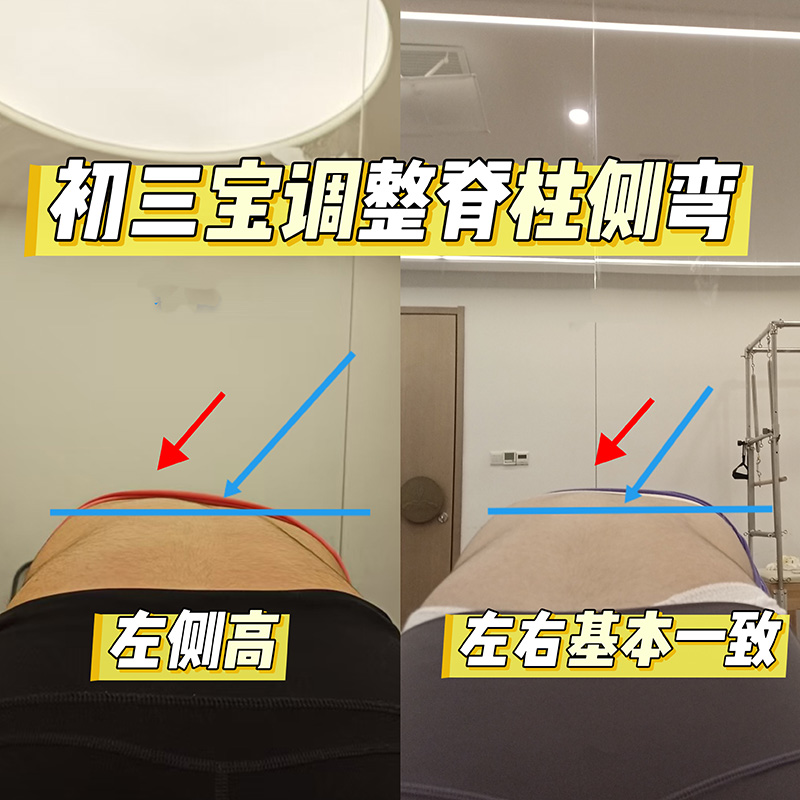 脊柱侧弯改善