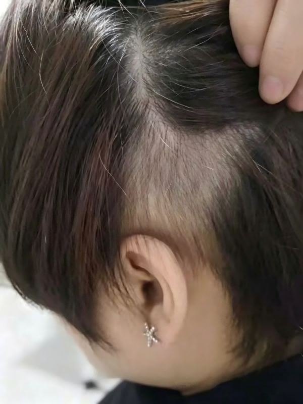 头皮局部区域养护