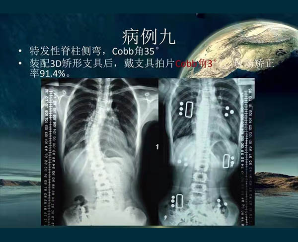 脊柱侧弯矫案例