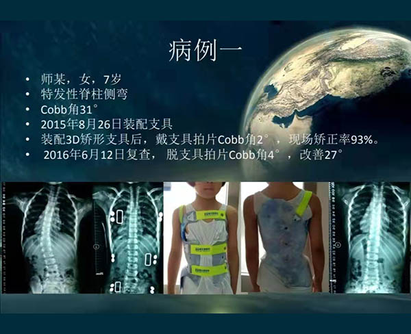 脊柱侧弯矫案例