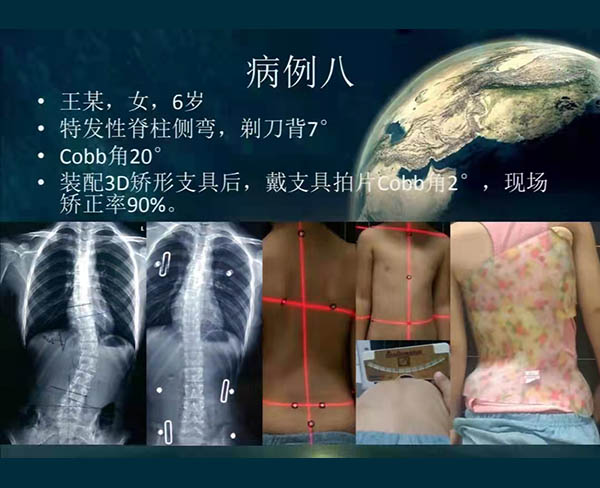 脊柱侧弯矫案例