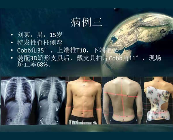 脊柱侧弯矫案例