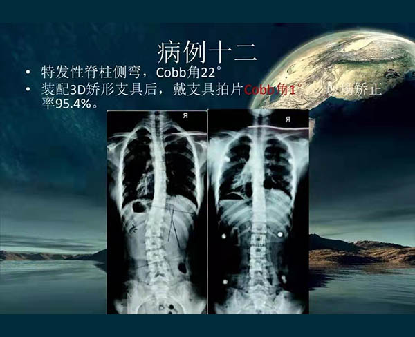 脊柱侧弯矫案例