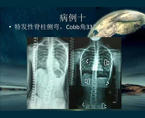 脊柱侧弯矫案例