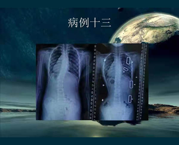脊柱侧弯矫案例