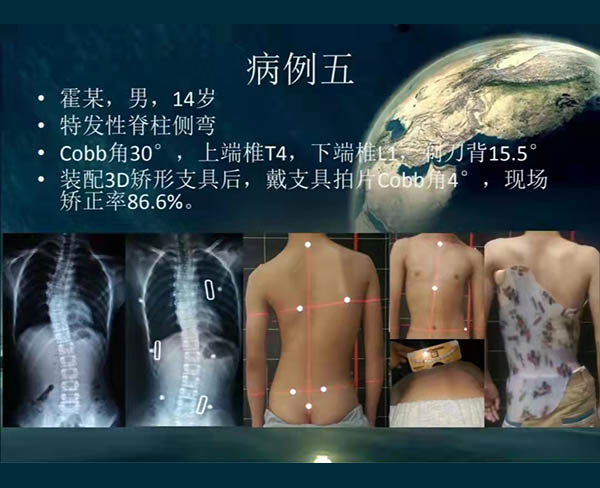 脊柱侧弯矫案例