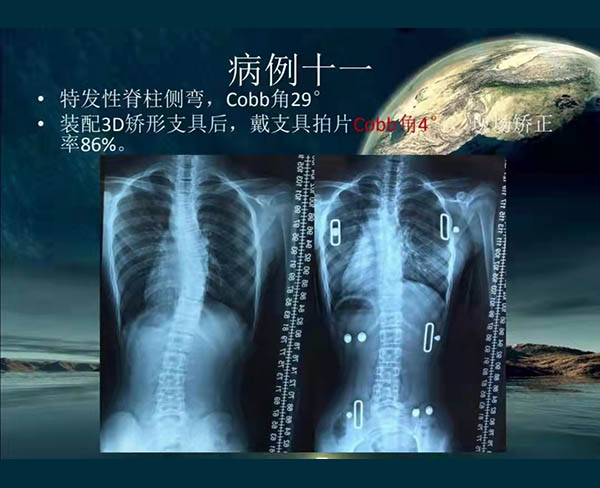 脊柱侧弯矫案例