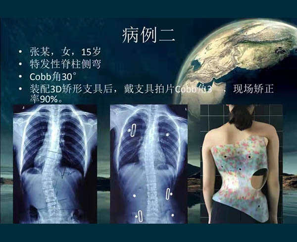 脊柱侧弯矫案例