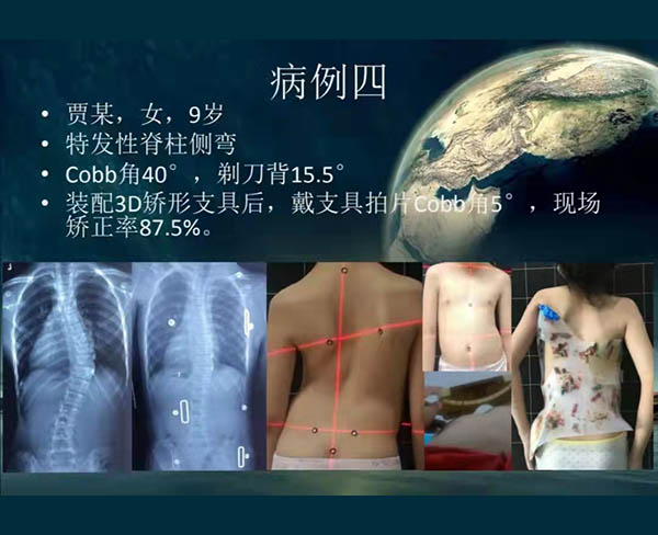 脊柱侧弯矫案例