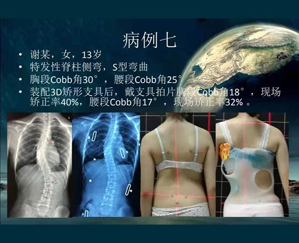 脊柱侧弯矫案例